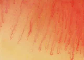 תמונה של קפילרוסקופיה תקינה: רואים סידור צפוף של קפילרות עם צורה תקינה